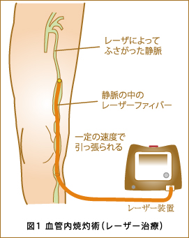 下肢静脈瘤の治療｜東京デイサージェリークリニック
